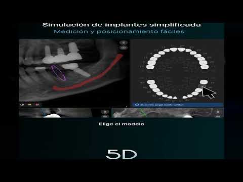 Miniatura original de SMARTDent 5D planificación implantes